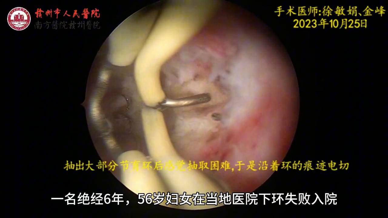 元宫型cu365节育环视频,你想了解的,我一次性说清楚 元宫型cu365节育环视频,你想了解的,我一次性说清楚